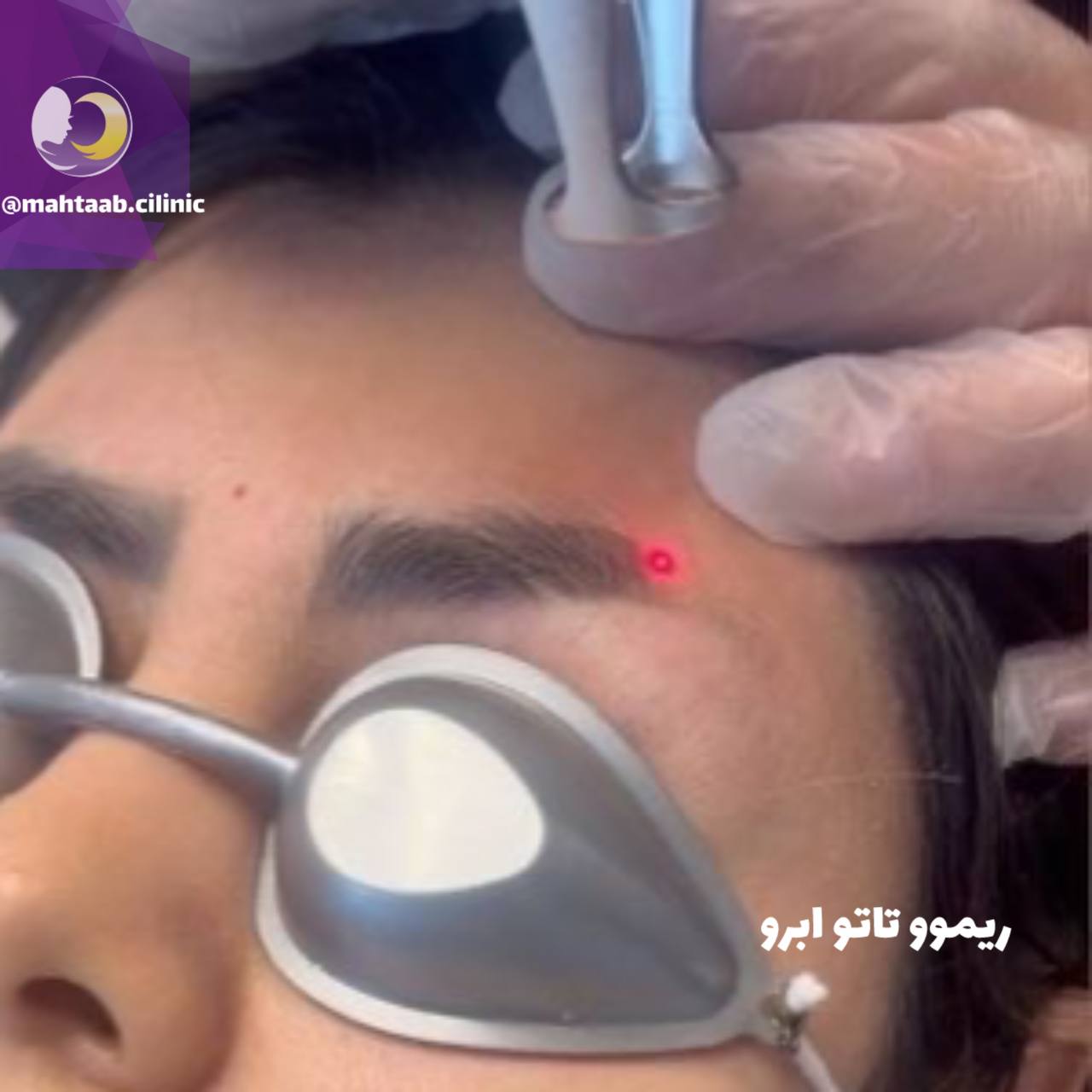 پاک کردن تاتو در کرج